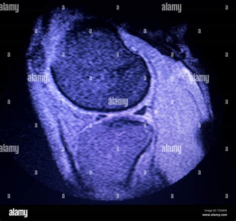 Magnetic resonance imaging MRI knee posterior horn medial meniscus tear scantest results Stock ...