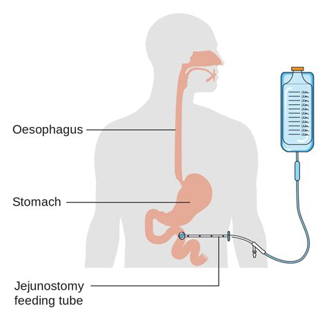 Decisão de Colocar Sonda Alimentar em Paciente que Não Come - Idosos