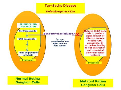 Tay-Sachs Disease | Hereditary Ocular Diseases