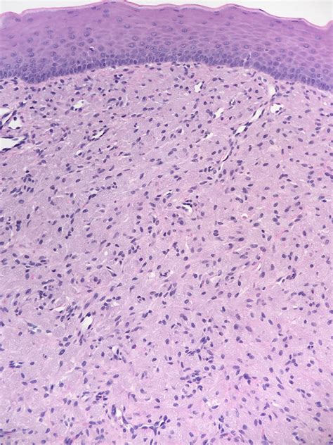 Congenital Epulis Histology