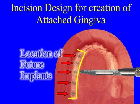 10 Pedicle Graft Procedure - Stuart Orton-Jones