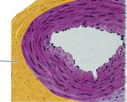 Solved 1)A patient with iliofemoral deep vein thrombosis | Chegg.com