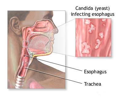 Ayurvedic Treatment for Esophageal Candidiasis - Symptoms, Causes ...