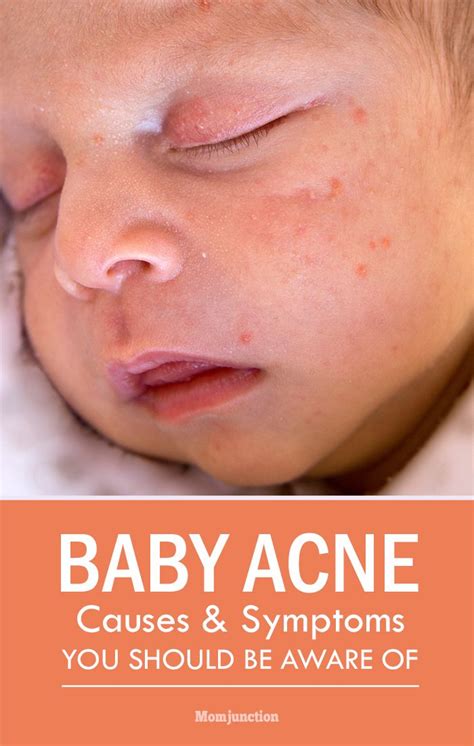 Baby Acne: What Causes Them And How You Can Prevent | Baby acne, New ...