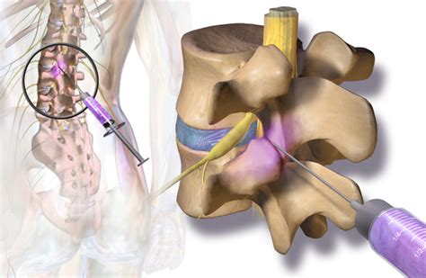 Facet Joint Injections | Aptiva Health