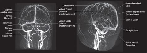 Cerebral venous thrombosis: a spectrum of imaging findings | SMJ