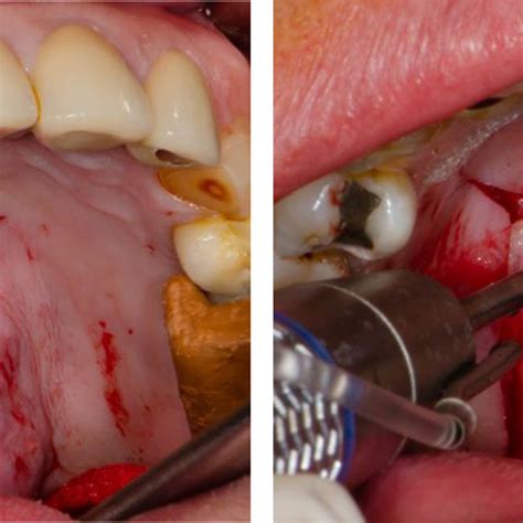 (PDF) Palatal torus: Etiology, clinical aspect, and therapeutic strategy