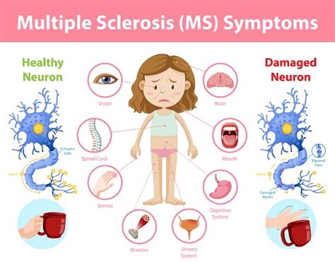 Multiple Sclerosis And Important Multiple Sclerosis Symptoms