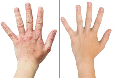 Dupixent Miraculously Cured My Eczema – The Skeptical Cardiologist