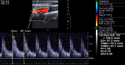 Carotid Artery Ultrasound