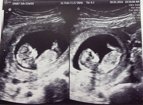 Fraternal Twins Ultrasound 12 Weeks | Twins! | Pinterest | Fraternal twins, Ultrasound and Twins