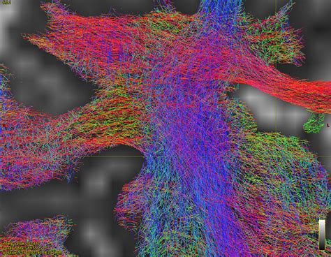 Global tractography results are not good - tractography - MRtrix3 Community