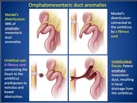 Omphalomesenteric Duct