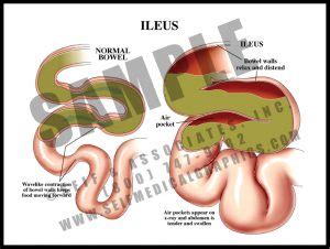 Lap Chole: Procedure - S&A Medical Graphics