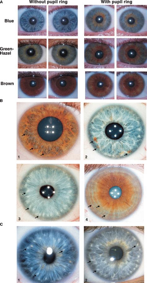 Genetics of human iris colour and patterns - Sturm - 2009 - Pigment Cell & Melanoma Research ...