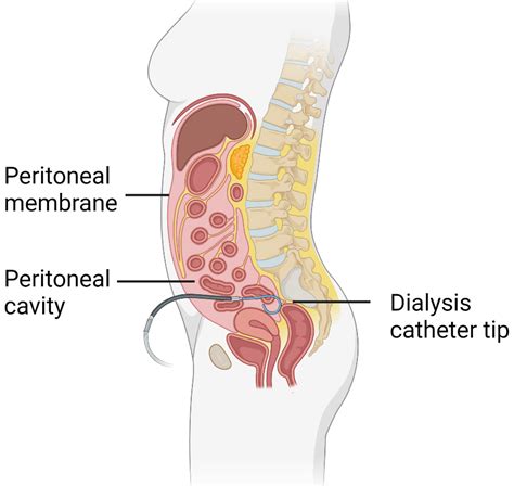 Peritoneal Dialysis — The Kidney Literacy Centre (Australia)