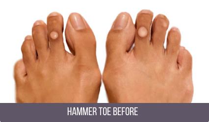 Hammer Toe Surgery NYC | Best Hammertoe Surgeon in New York City