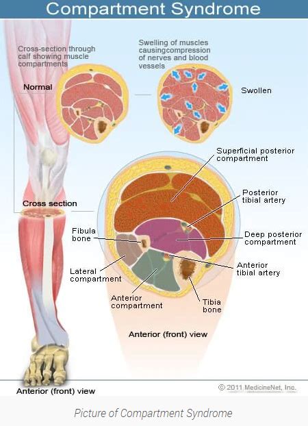 Compartment Syndrome Lower Leg Surgery Recovery Time - Captions Trendy