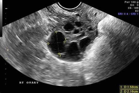 2D Ultrasound in Follicle Monitoring for ART | Radiology Key