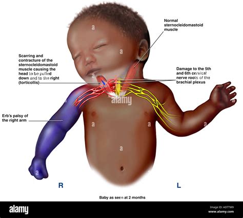 Brachial Plexus Injury Symptoms