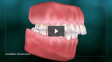 Malocclusion (Class II) - Westney