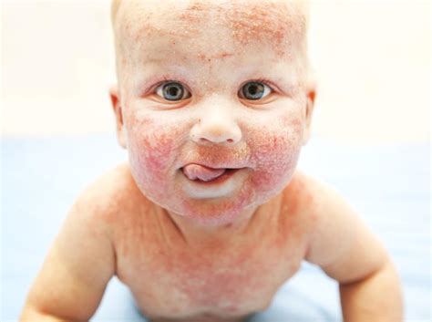 Atopic dermatitis tied to increased tooth decay risk in children | News for Doctor, Nurse ...