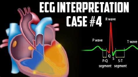 ECG interpretation case #4|pericarditis ECG|EKG|educational video - YouTube