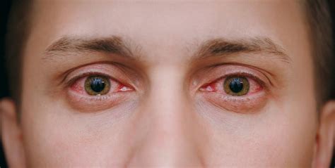 The Many Causes of Chronic Red Eyes: Valley Eye Professionals (An Optometric Corporation ...