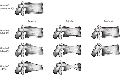 Spine Fracture Classification