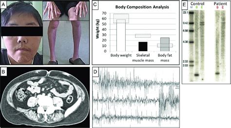 Clinical features and diagnosis of a patient with myotonic dystrophy... | Download Scientific ...