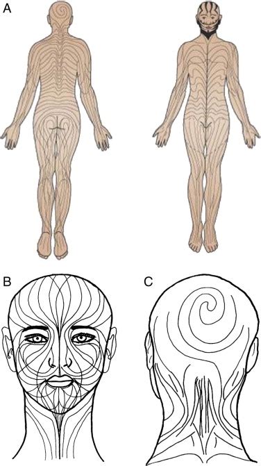 Blaschko lines and other patterns of cutaneous mosaicism - Clinics in ...