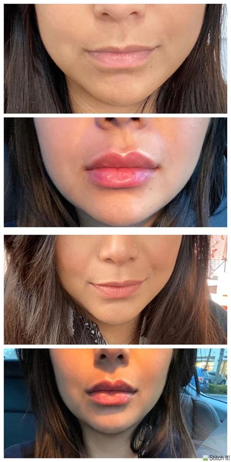 Got lip filler today - Pic of lips before and immediately after 1 ...