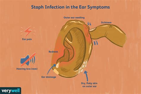 Qué causa las infecciones por estafilococos en el oído y cómo tratarlas ...