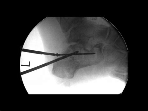 Calcaneal fracture: Percutaneous fixation of Tongue-type fracture ...