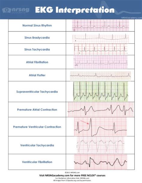 Interpret EKGs Like a Boss! (ekg interpretation for nurses) — NRSNG | Where Nurses Learn ...