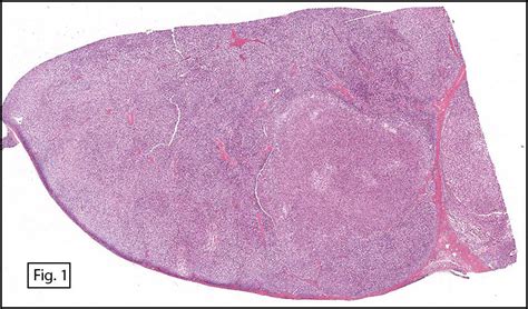 Cancer Diagnosis: Diagnosis Renal Cell Cancer