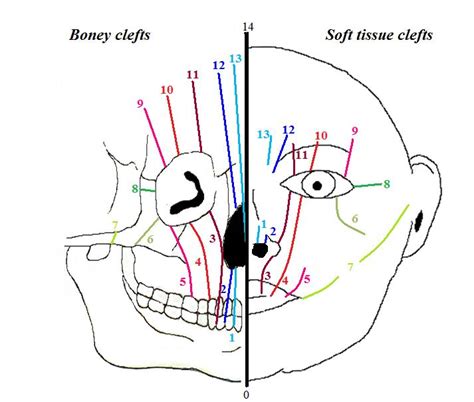 Hypertelorism