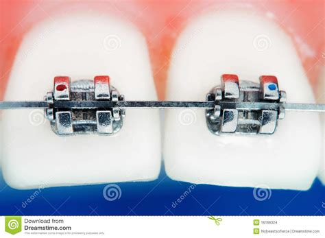 Front Teeth Braces Stock Images - Image: 16166324