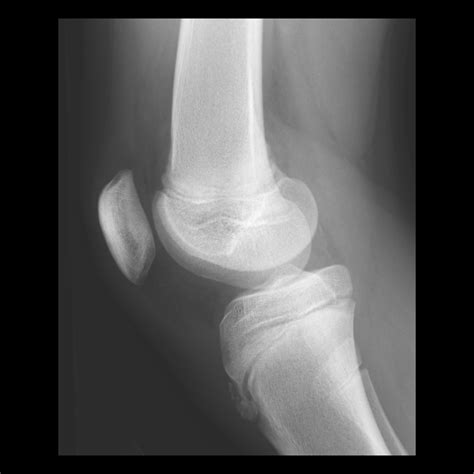 Osgood-Schlatter Disease | Pediatric Radiology Reference Article | Pediatric Imaging | @pedsimaging