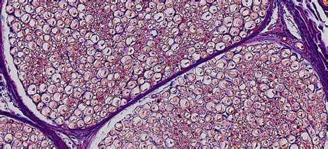 Neurofibromatosis | Condition | UT Southwestern Medical Center