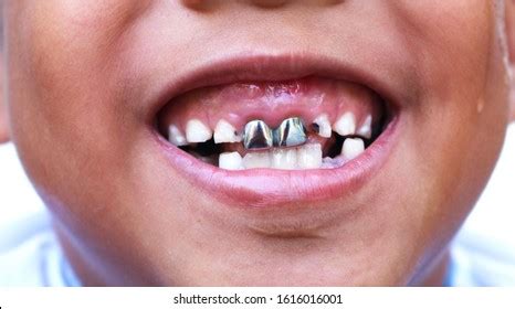 Smiling Tooth Decay Silver Crown Closeup库存照片1616016001 | Shutterstock