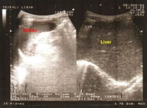 Ultrasound image showing a mild hepatomegaly. | Download Scientific Diagram