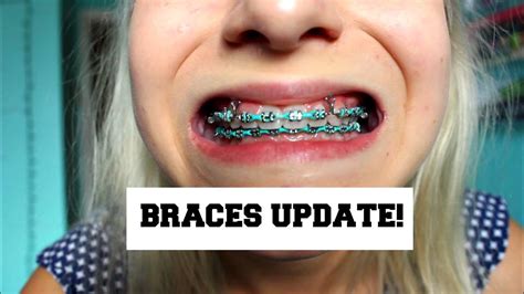 BRACES UPDATE! New wire and brackets|| Lilyslounge14 - YouTube