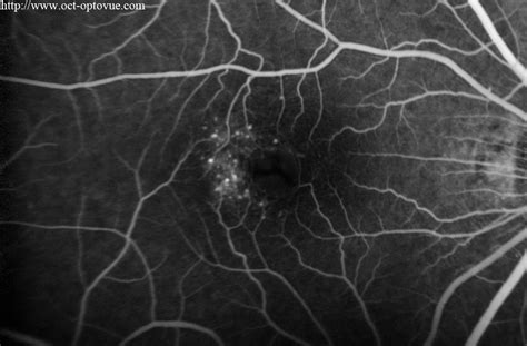 OCT angiography & macular telangiectasia