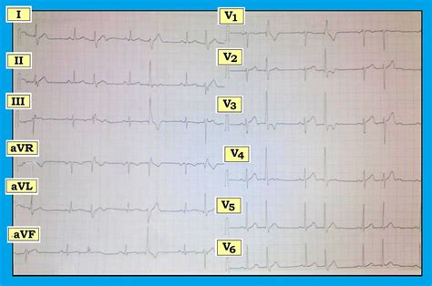 ECG Interpretation: ECG Blog #140 – (PVC – Atrial Bigeminy – PAC – LAHB – RBBB – LPHB – Aberration).