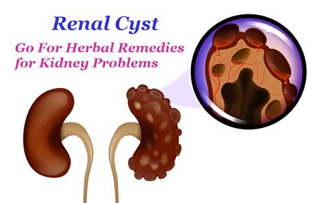 Renal Cyst – Go For Herbal Remedies for Kidney Problems - Kundan Kidney Care Centre