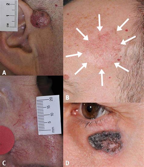 Facial basal cell carcinoma | The BMJ