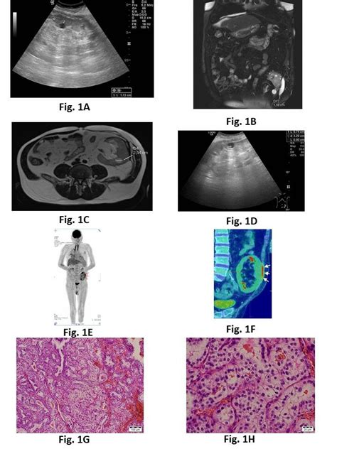 A. Ultrasound of the abdomen -cortical cysts in transplanted kidney,... | Download Scientific ...