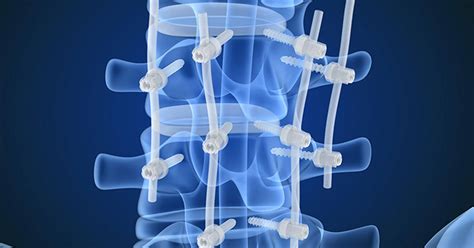 Posterior Lumbar Interbody Fusion (PLIF) - PracticeMarketingRx