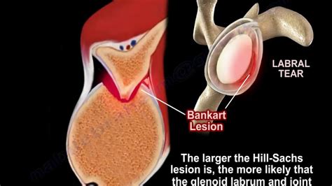 LESION DE BANKART Y HILL SACHS PDF